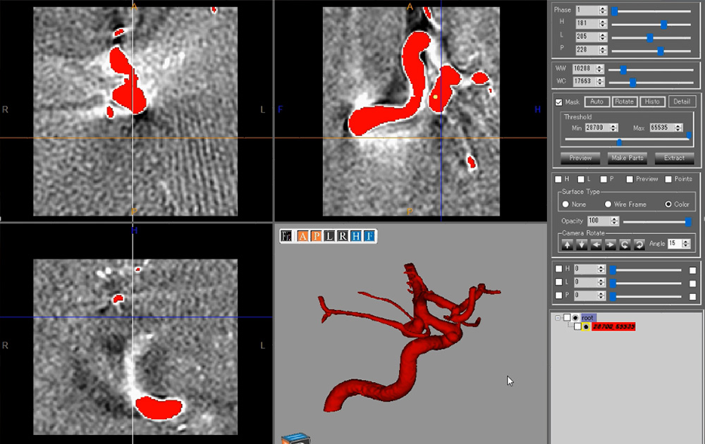 医療３Ｄモデリングプログラムによる立体化